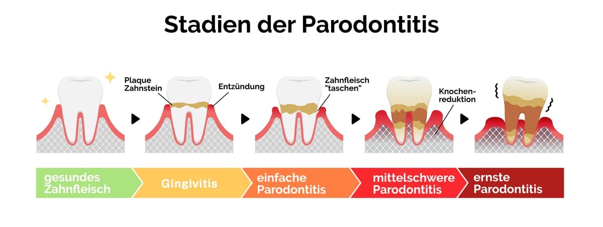 schematische Darstellung der Stadien der Parodontitis